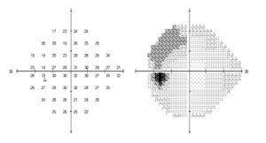 Visual field showing missing vision from glaucoma.
