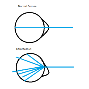 keratoconous diagram